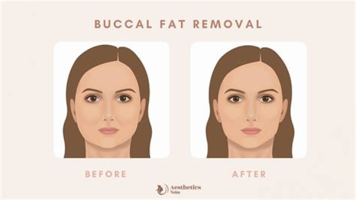 Celebrity Buccal Fat Removal: The Ultimate Guide to Achieving a Slimmer Face