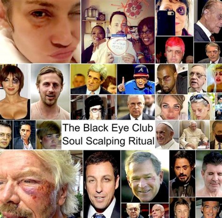 The Black Eye Club: Decoding the Conspiracy & Celebrity Black Eyes